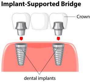 dental bridges